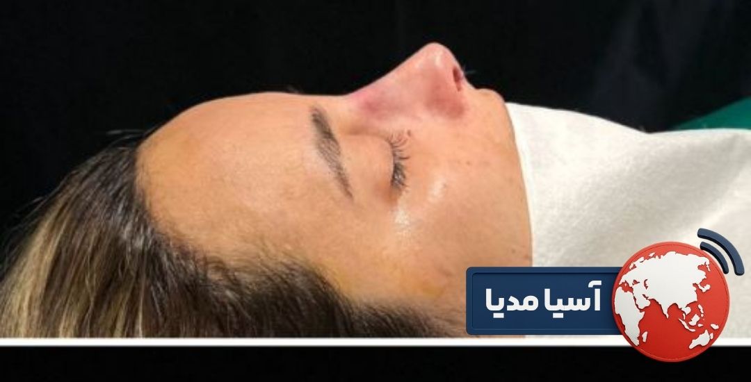 هزینه عمل بینی و قیمت عمل بینی سال ۱۴۰۴