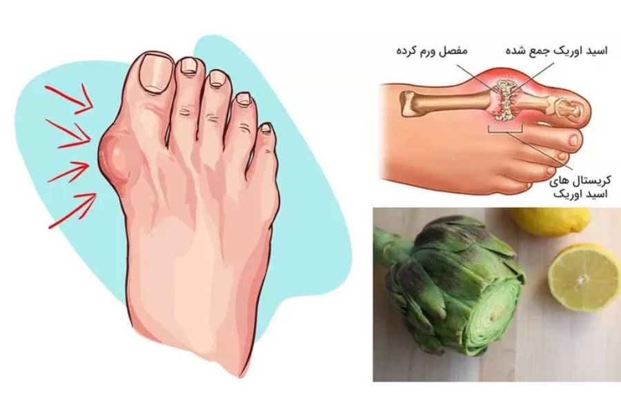 علائم بالینی اسید اوریک بالا