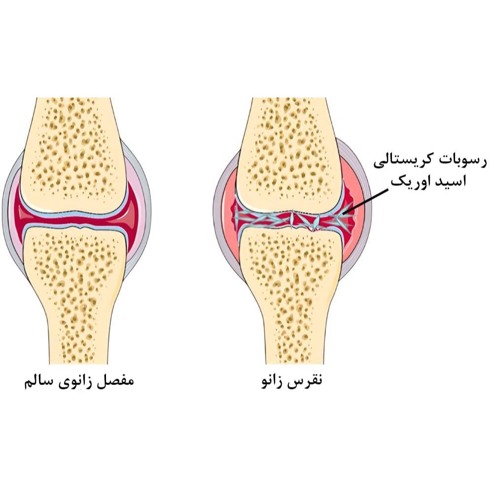 علائم اوریک اسید بالا