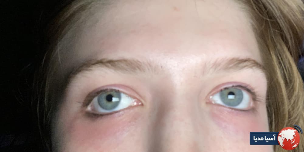ترکیبات کرم‌های دور چشم و تاثیر آن‌ها بر پوست حساس اطراف چشم