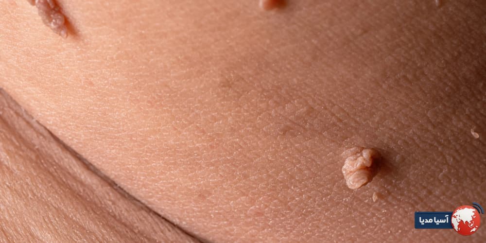 چرا پرسش درباره رابطه بعد از لیزر زگیل تناسلی مهم است؟