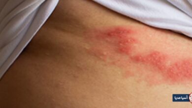 آیا بعد از لیزر زگیل تناسلی میتوان رابطه داشت