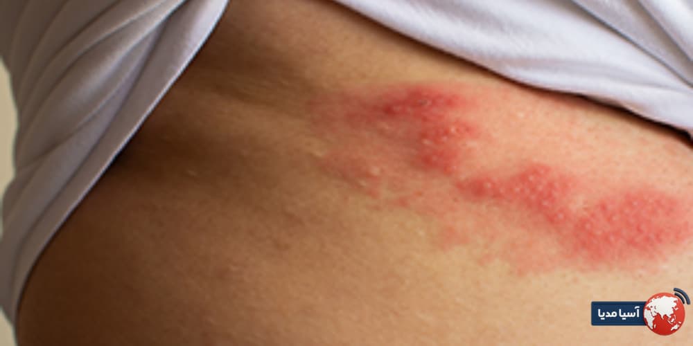 آیا بعد از لیزر زگیل تناسلی میتوان رابطه داشت