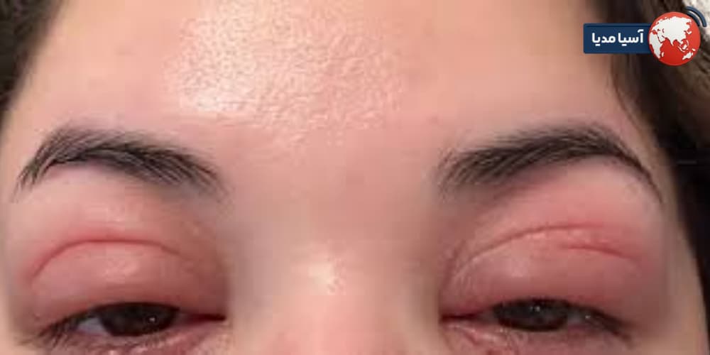 عواملی که باعث حساسیت پوست دور چشم می‌شوند